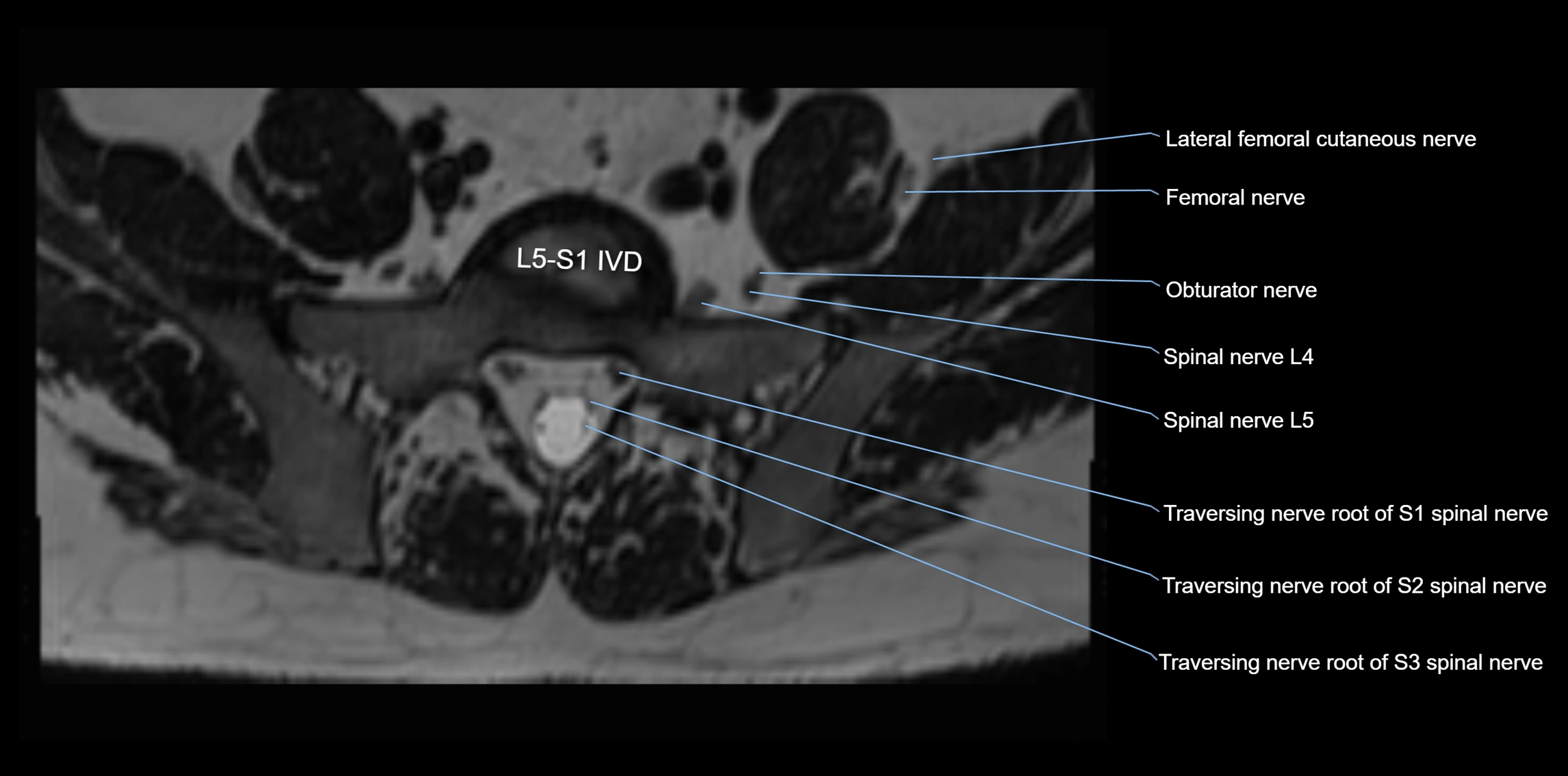 MR lumbosacral plexus axial cross sectional anatomy 3T  radiology  image-img-1008001-00067.webp